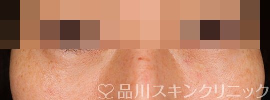 症例NO.67524のAFTER写真