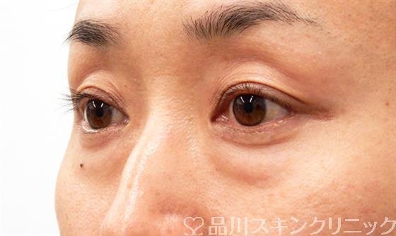 症例NO.53005のBEFORE写真