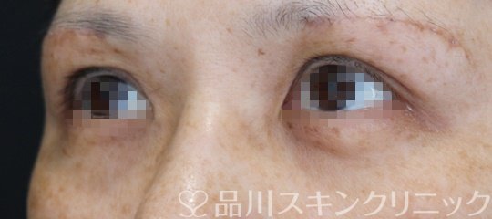 症例NO.64593のBEFORE写真