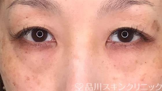 症例NO.54668のBEFORE写真