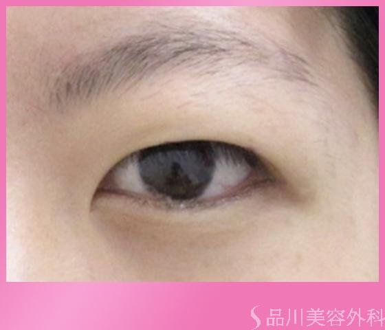 症例NO.1580のBEFORE写真