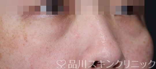 症例NO.65836のBEFORE写真