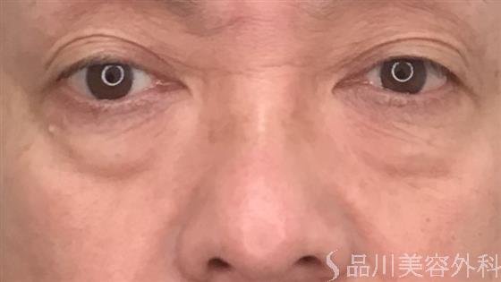 症例NO.54246のBEFORE写真