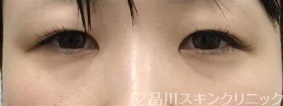 症例NO.48779のBEFORE写真