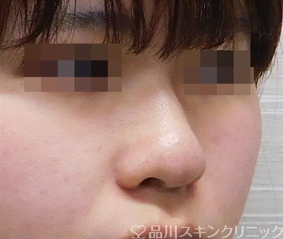 症例NO.48066のBEFORE写真