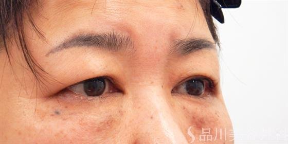 症例NO.53706のBEFORE写真