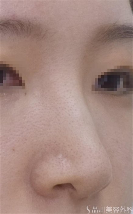 症例NO.52949のBEFORE写真