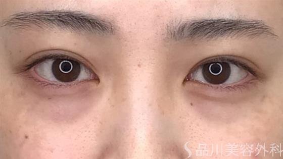 症例NO.59435のBEFORE写真