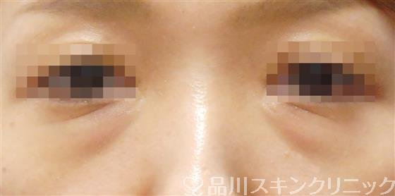 症例NO.42546のBEFORE写真