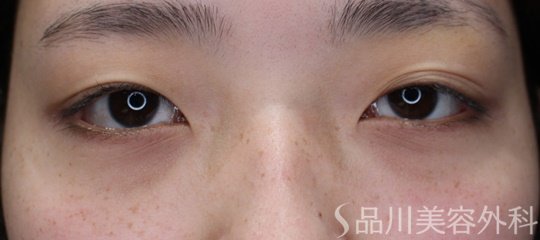 症例NO.66916のBEFORE写真