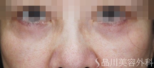 症例NO.68902のAFTER写真