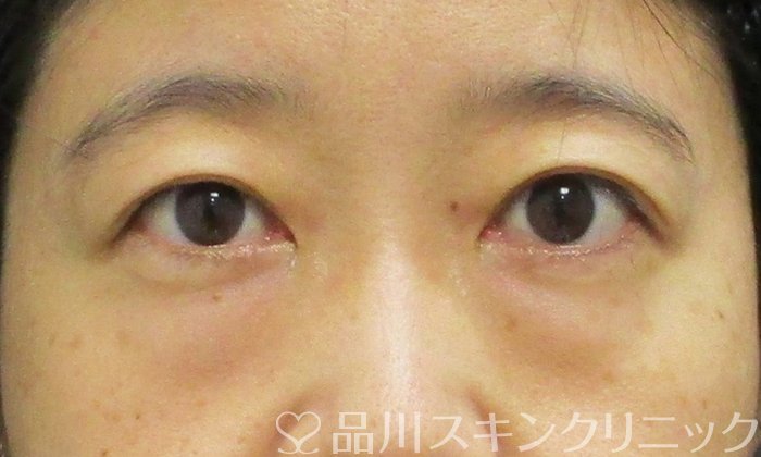 症例NO.67196のBEFORE写真