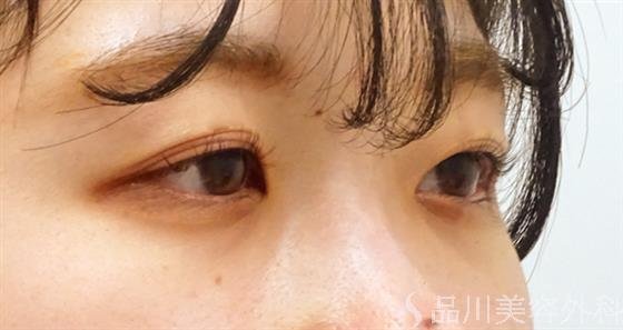 症例NO.53729のBEFORE写真