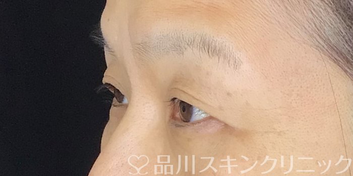 症例NO.66735のBEFORE写真