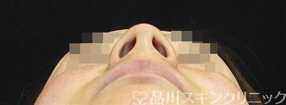 症例NO.60871のAFTER写真