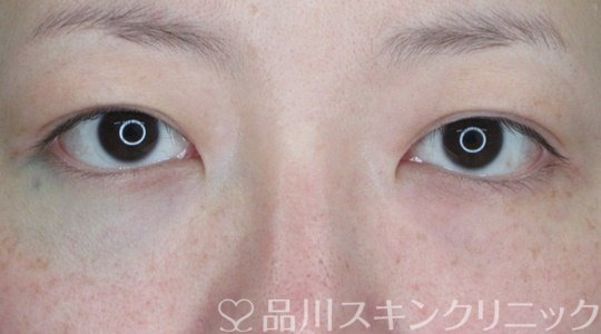 症例NO.68366のBEFORE写真