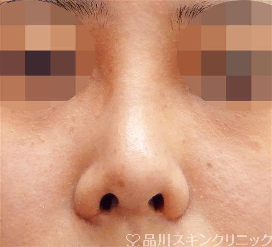 症例NO.45707のAFTER写真