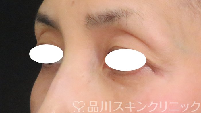 症例NO.63128のBEFORE写真