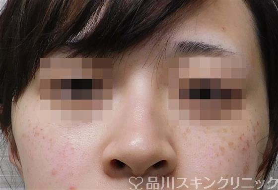 症例NO.51843のBEFORE写真