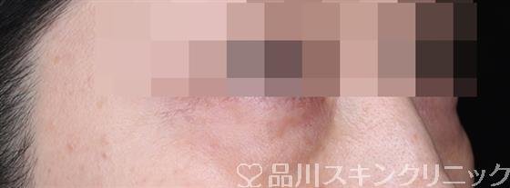 症例NO.55510のBEFORE写真