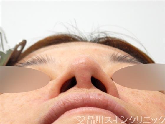 症例NO.52388のBEFORE写真