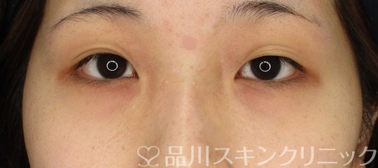 症例NO.64637のBEFORE写真