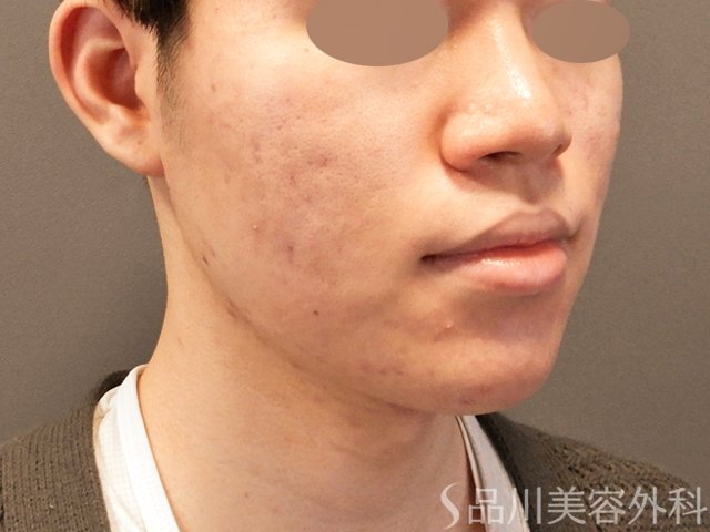 症例NO.67092のBEFORE写真