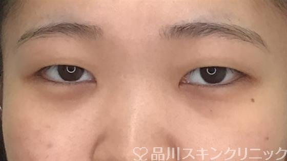 症例NO.56620のBEFORE写真