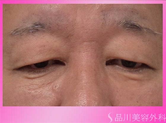 症例NO.29707のBEFORE写真