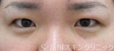 症例NO.67300のBEFORE写真