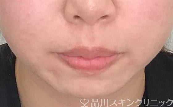 症例NO.52174のBEFORE写真