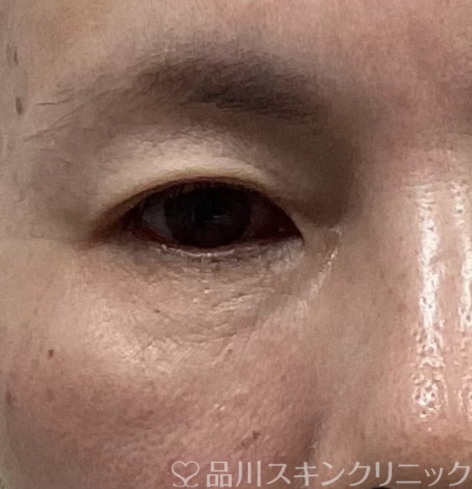 症例NO.68153のBEFORE写真