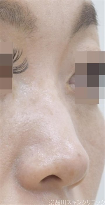 症例NO.52917のBEFORE写真