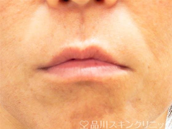 症例NO.52660のBEFORE写真