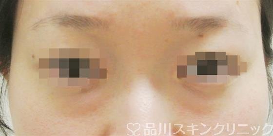 症例NO.34899のBEFORE写真