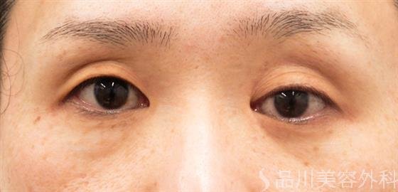 症例NO.52906のBEFORE写真