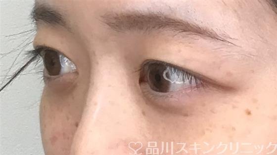 症例NO.56408のBEFORE写真