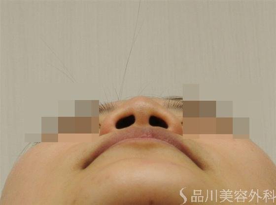 症例NO.18414のBEFORE写真