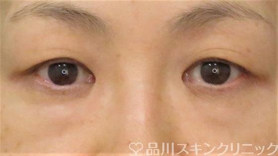 症例NO.59237のBEFORE写真