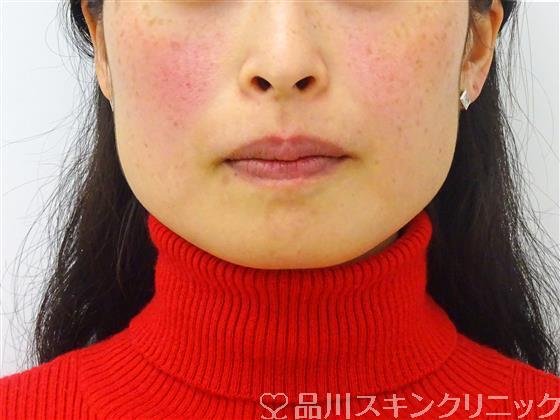 症例NO.45200のBEFORE写真