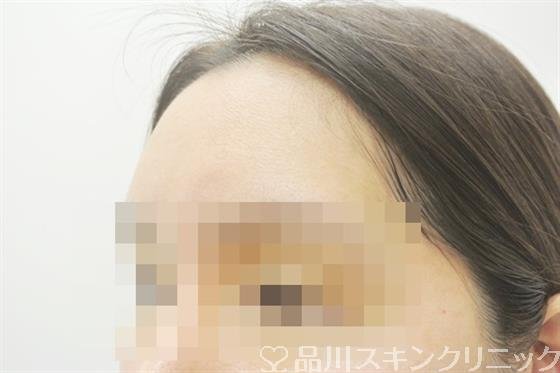 症例NO.38621のBEFORE写真