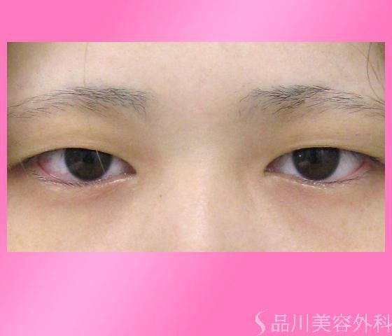 症例NO.2031のBEFORE写真