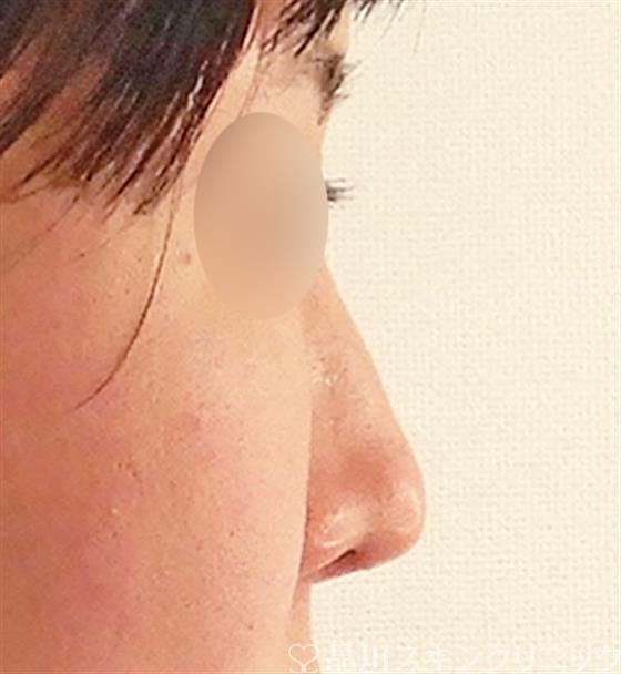 症例NO.58726のBEFORE写真