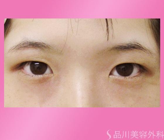 症例NO.124のBEFORE写真