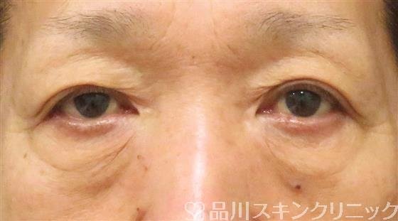 症例NO.61825のBEFORE写真