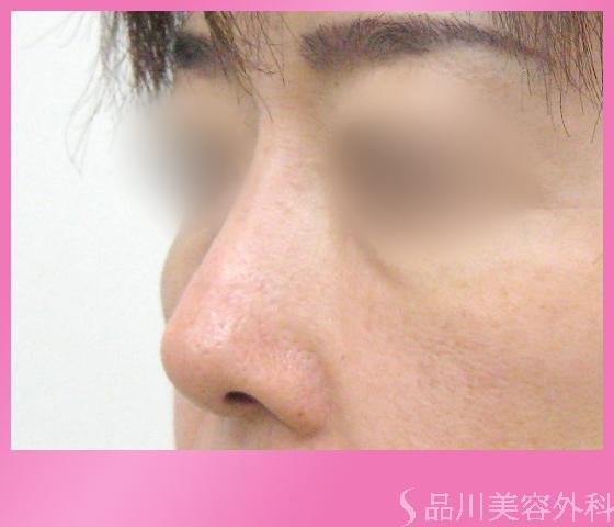 症例NO.1127のBEFORE写真