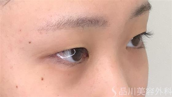 症例NO.56346のBEFORE写真