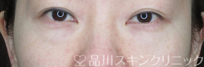 症例NO.65940のBEFORE写真