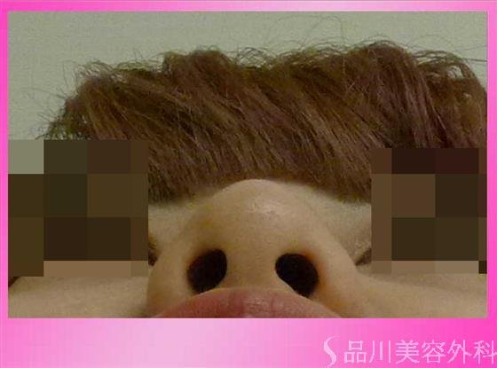 症例NO.33872のAFTER写真