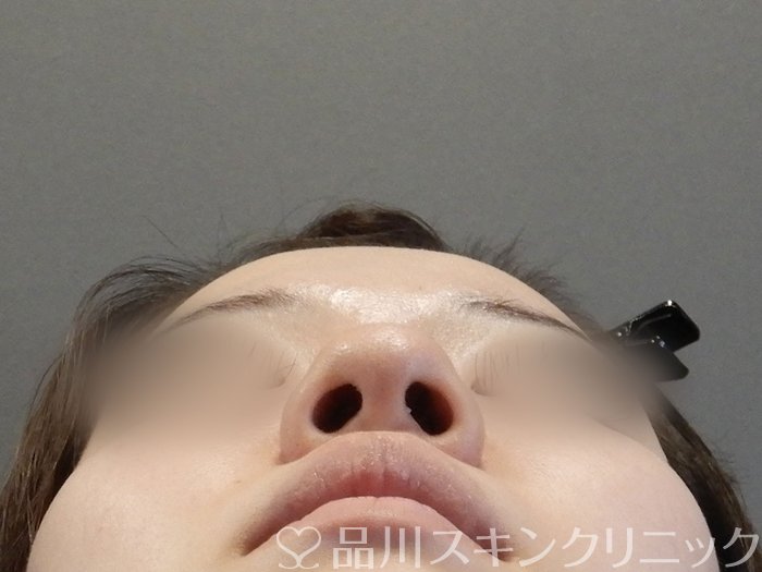 症例NO.65320のBEFORE写真